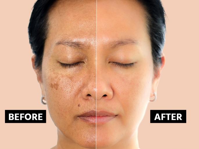 Blackened skin around the lips? What is the solution, experts say.. | ओठांभोवतीची त्वचा काळी पडलीय? त्यावर उपाय काय, तज्ज्ञ सांगतात..