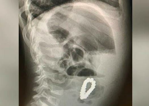 boy swallow magnetic bracelet 4 year old complains of stomach pain doctors find magnetic bracelet inside | धक्कादायक! 4 वर्षीय मुलाच्या पोटात सापडलं मॅग्नेटिक ब्रेसलेट, एक्स-रे पाहून डॉक्टरही हैराण boy swallow magnetic bracelet 4 year old complains of stomach pain doctors find magnetic bracelet inside | धक्कादायक! 4 वर्षीय मुलाच्या पोटात सापडलं मॅग्नेटिक ब्रेसलेट, एक्स-रे पाहून डॉक्टरही हैराण