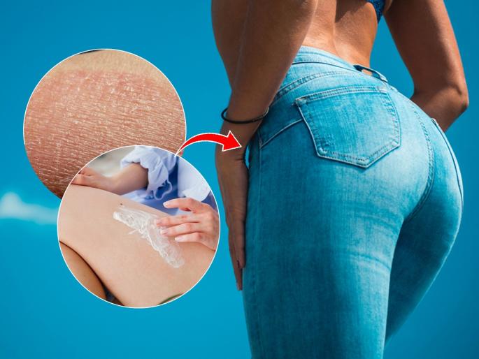 Dark spots on hips, dry skin, itching? 3 solutions, dryness will be reduced | हिप्सवर काळे डाग पडलेत, त्वचा ड्राय झाली, खाज सुटते? ३ उपाय, ड्रायनेस होईल कमी