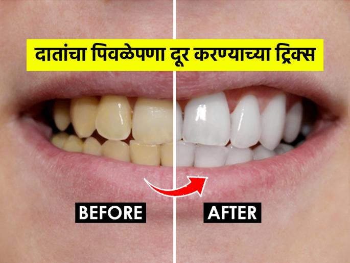 Yellow Teeth Solution : How to get rid from yellow teeth 5 Simple Ways to Naturally Whiten Your Teeth at Home | रोज कितीही घासले तरी दात पिवळेच दिसतात? ५ सोपे उपाय, पांढरेशुभ्र-चमकदार दिसतील दात
