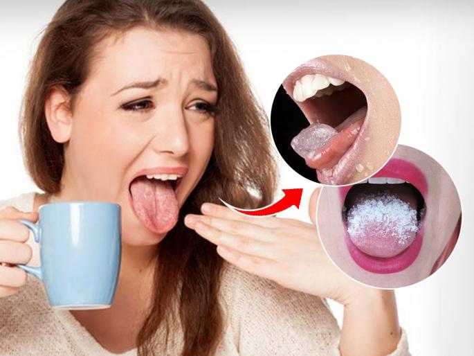 How To Heal Burnt Tongue 5 Effective Home Remedies | जेवताना जीभ चावली - दाताखाली आली? चटकन करा ५ उपाय - आग होईल कमी...