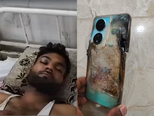seoni 27000 phone blasted on mans face close shave with death horrible story police fir | बापरे! 27 हजारांचा नवा फोन घेतला अन् आठवडाभरात ब्लास्ट झाला; तरुण गंभीर जखमी seoni 27000 phone blasted on mans face close shave with death horrible story police fir | बापरे! 27 हजारांचा नवा फोन घेतला अन् आठवडाभरात ब्लास्ट झाला; तरुण गंभीर जखमी