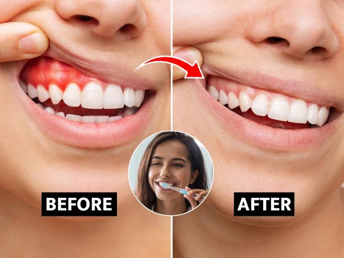 Do bleeding gums always mean gum disease? | सतत हिरडीतून रक्त येते? हा आजार की गंभीर आजाराची लक्षणे? डॉक्टर सांगतात..