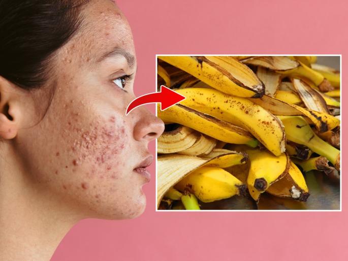 How to use banana peels to treat pigmentation and acne marks | केळीच्या सालीचा करा फेसपॅक ! पिंपल्स, काळे डाग आणि डार्क सर्कल्स घालविण्याचा सोपा उपाय...