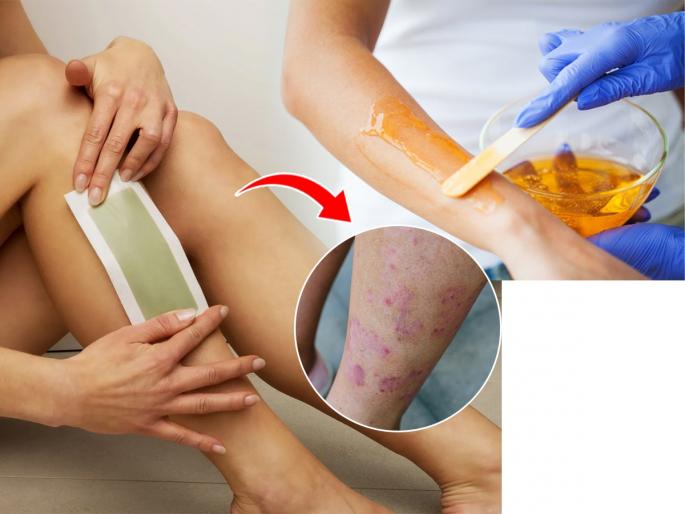 What to do if you get a rash after waxing? | व्हॅक्सिंगनंतर त्वचेवर रॅश येते? लाल चट्टे-पूरळ उठते? अशावेळी काय करायचं?