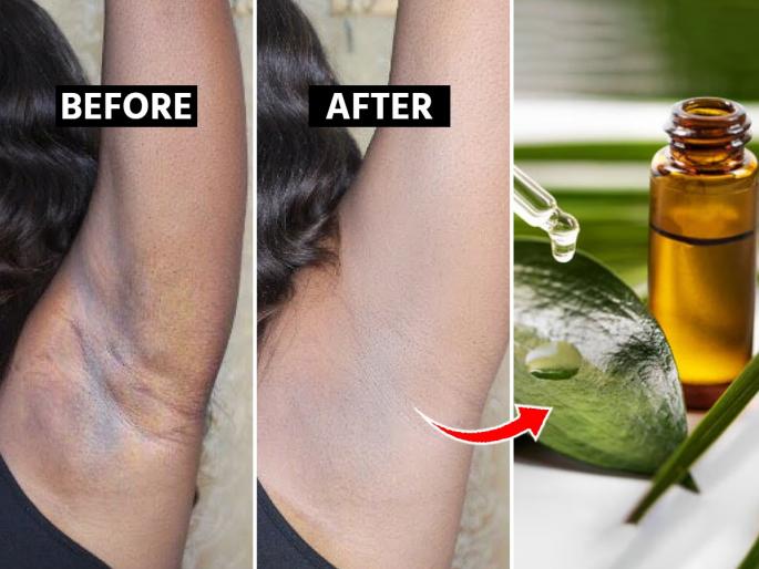 Home Remedies For Dark Underarms : Home remedies to lighten dark underarms | दंड गोरे पण अंडरआर्म्स खूप काळे? १ उपाय, काखेतला काळपटपणा जाईल-घामाची दुर्गंधीही कमी