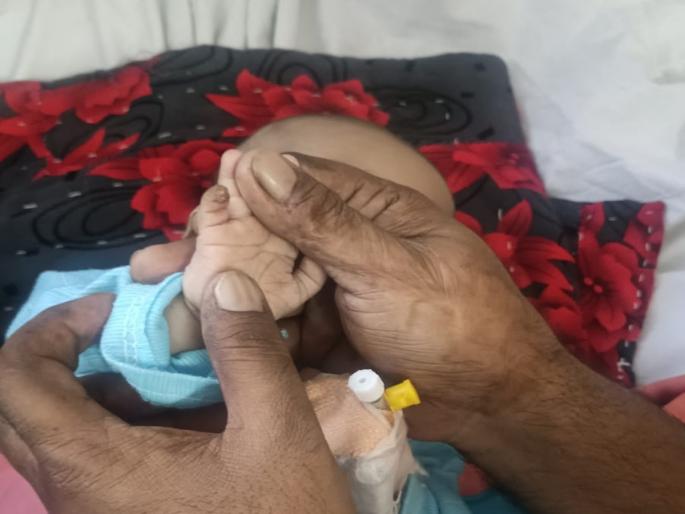 Shocking! Scissors cut the little finger of a six-month-old baby while cutting the bandage | धक्कादायक! कात्रीने कापायची होती हाताची पट्टी, कापली गेली ६ महिन्याच्या बाळाची करंगळी Shocking! Scissors cut the little finger of a six-month-old baby while cutting the bandage | धक्कादायक! कात्रीने कापायची होती हाताची पट्टी, कापली गेली ६ महिन्याच्या बाळाची करंगळी