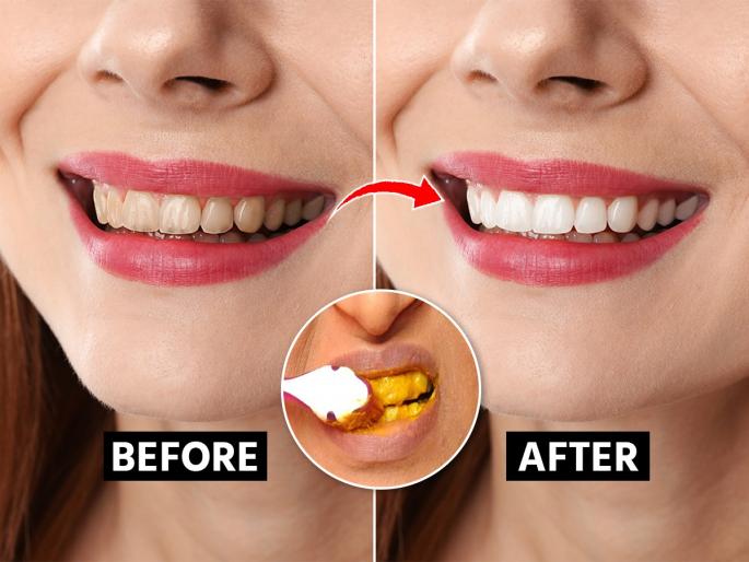 How To Whiten Teeth Naturally With Turmeric | हळद लावा-दात पिवळे नाही होणार उलट पांढरेशुभ्र होऊन चमकतील, घ्या हळीदीचे ३ सोपे उपाय