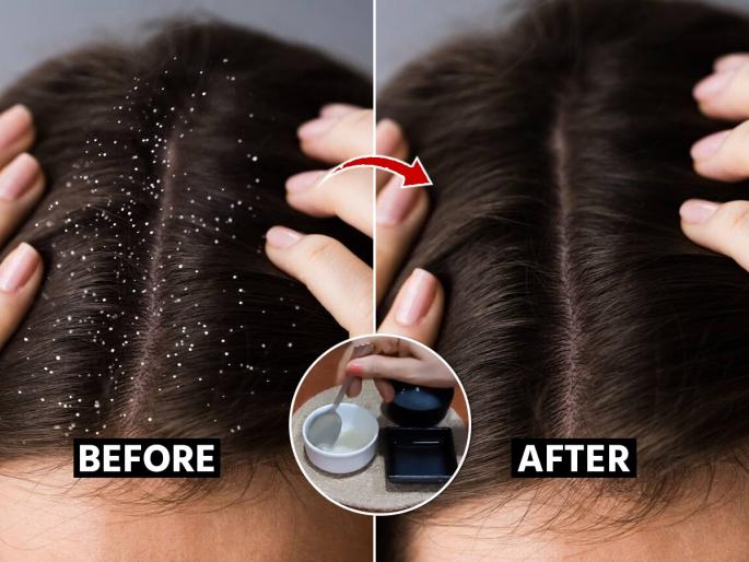 How to get rid of dandruff and itchy scalp, How to treat itchy scalp at home, Home remedies for dandruff and itchy scalp | केसांत खूपच कोंडा झाला- डोक्यात सतत खाज येते? केस धुण्याच्या आधी फक्त १ काम करा- कोंडा कमी होईल