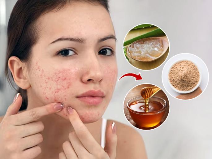 3 Natural Ways to Get Rid of Pimples as Fast as Possible | चेहऱ्यावर छोटे दाणे-मुरुमांच्या डागांमुळे त्रस्त? ३ घरगुती उपाय, चेहरा होईल क्लिन-मिळेल नैसर्गिक ग्लो