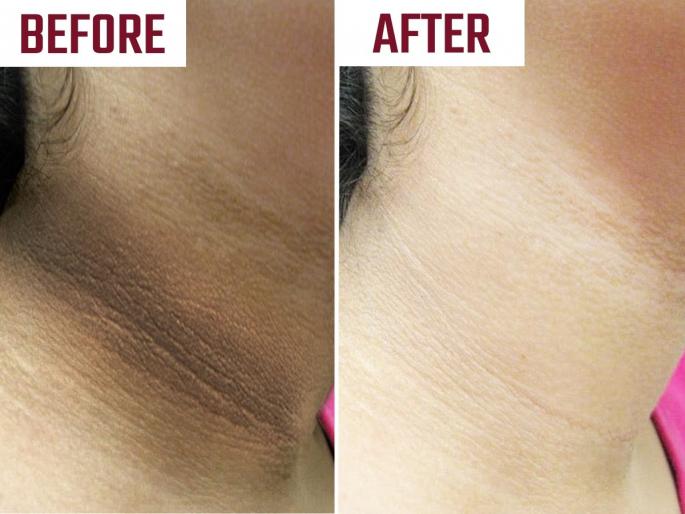 How to Remove Neck Tanning : Top 8 Neck Tan Removal Tips Easy Neck Tanning Removal Tips | चेहरा गोरा पण मानेवर काळे थर आलेत? किचनमधले 'हे' पदार्थ लावा, टॅनिंग निघेल-त्वचा चमकेल