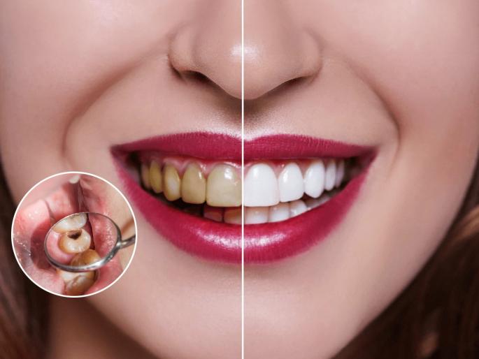 How to Get Rid Of Yellow Teeth : Simple Home Remedies To Whiten Your Teeth Naturally | दातांवर पिवळा चिकट थर-किड लागली? किचनमधले ५ पदार्थ लावा; पांढरेशुभ्र होतील दात