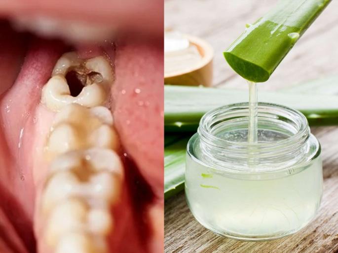 Follow These Tips To Remove Cavity From Teeth : How to Remove Cavity From Teeth Home Remedy | दातांच्या मध्यभागी किड-वरून पिवळे झाले? किचनमधल्या ३ वस्तू लावा, किड निघेल-स्वच्छ होतील दात