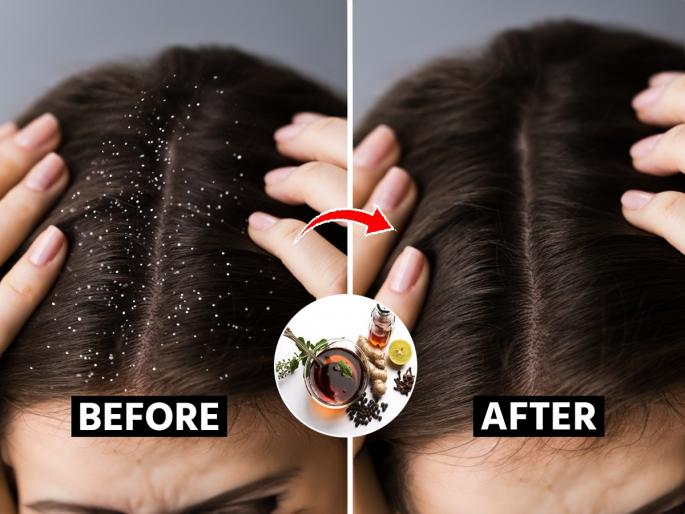 Ayurvedic remedies for reducing dandruff, how to get rid of dandruff, best remedies for dandruff free scalp | डोक्यात सतत कोंडा होतो, चेहराही खराब झाला? १ आयुर्वेदिक उपाय- कोंडा कायमचा निघून जाईल