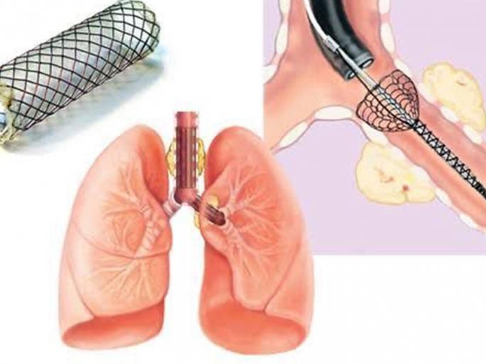 Esophageal cancer, hole in airway, still a survivor | अन्ननलिकेचा कर्करोग, श्वसनमार्गात छिद्र, तरीही वाचला जीव Esophageal cancer, hole in airway, still a survivor | अन्ननलिकेचा कर्करोग, श्वसनमार्गात छिद्र, तरीही वाचला जीव