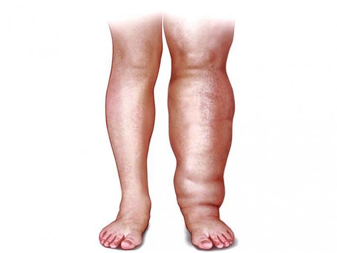 Amphibious patients will get the support of disability certificate | हत्तीपाय रुग्णांना मिळणार दिव्यांग प्रमाणपत्राचा आधार