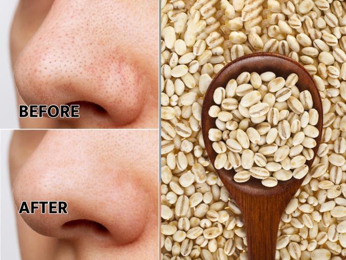 how to get rid of blackheads and whiteheads, home remedies for removing blackheads and whiteheads | ब्लॅकहेड्स, व्हाईटहेड्स चेहऱ्यावर कधीच येणार नाहीत! 'हे' पांढरं पाणी प्या- चेहरा होईल स्वच्छ