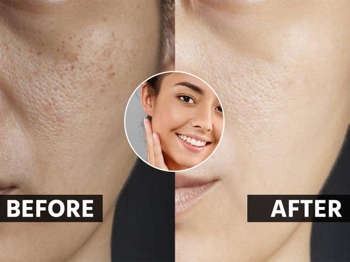 best home remedies for open pores, how to get rid of open pores, best home treatments for Open Pores, Large Pores, Clogged Pores | ओपन पोअर्स वाढल्याने चेहरा खूपच वयस्कर दिसतो? ४ सोप्या टिप्स- ओपन पोअर्स कमी होतील