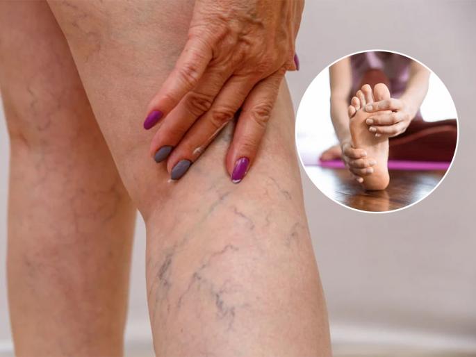 3 important rules for the people suffering from varicose veins, how to reduce varicose veins problem | ऐन तारुण्यात व्हेरिकोज व्हेन्सचा त्रास? चुकूनही करु नका ३ गोष्टी, दुखणं होईल कमी