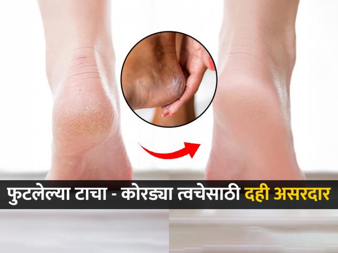 How to heal cracked heels in winters Effective Home Remedy to Heal Cracked Heels Remove Cracked Heels By Using Curd | हिवाळ्यात टाचांना भेगा पडल्या, कोरडी त्वचा? बस्स वाटीभर दही काफी है! पाहा खास उपाय...