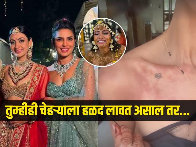 Priyanka Chopra's 'Bhabhi', Neelam Upadhyay Faces Skin Allergy After Applying 'Haldi' Paste In Pre-Wedding | प्रियांका चोप्राच्या भावजयीला हळदीची ॲलर्जी, लग्नात खांद्यावर लालसर चट्टे- डॉक्टर सांगतात ‘या’ ॲलर्जीचं कारण..