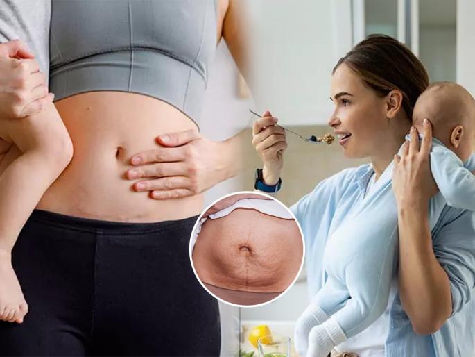 avoid this 5 food after c section delivery pregnancy care tips postpartum foods | सिझेरिअन झालं असेल तर ४ पदार्थ खाणं टाळा, बाळांतपणानंतर चांगल्या आरोग्यासाठी घ्या काळजी