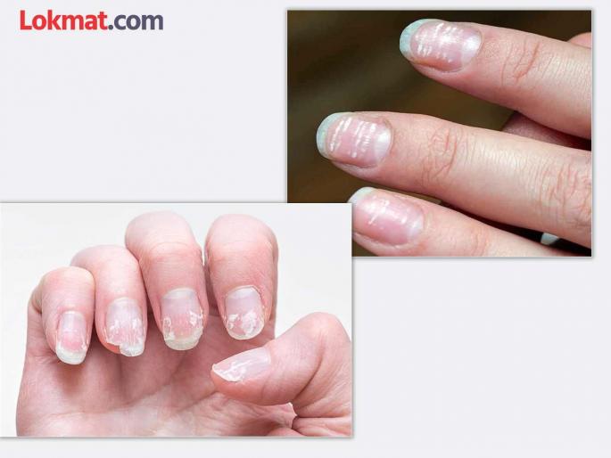 White spots on nails, crooked nails; do you know the reasons? | नखांवर पांढरे डाग, वेडीवाकडी नखं; कारणं माहीत आहेत का?