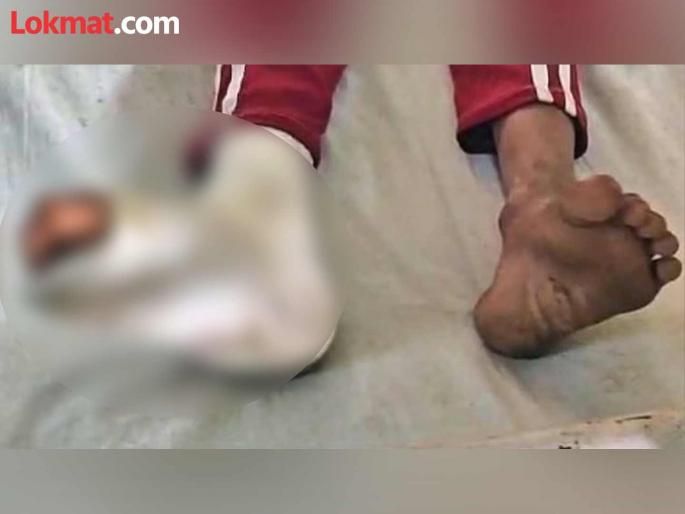 teacher in hardoi sat on student back child kept groaning in pain leg got fractured | संतापजनक! तिसरीतील विद्यार्थ्याला 'कोंबडा' बनवून पाठीवर बसला शिक्षक; मुलाचा पाय फ्रॅक्चर