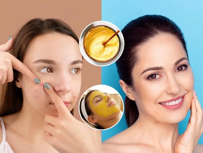 best home remedies for removing pimples and tanning, how to get clear skin, home made face pack for removing tanning | गुढीपाडवा : शोभायात्रेला नटून जायचंय, पण पिंपल्सचं टेंशन? 'हा' घरगुती उपाय- टॅनिंग -पिंपल्स गायब