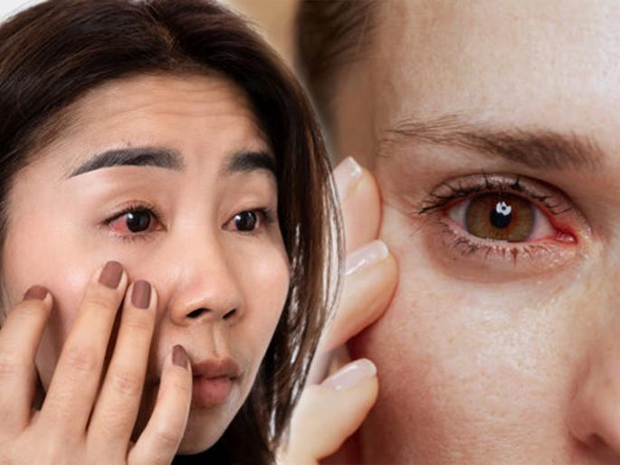 Are your eyes tearing? See what are the causes and remedies | डोळे चुरचूरतात ? सारखे डोळ्यातून पाणी येते? पाहा काय आहेत कारणे व उपाय