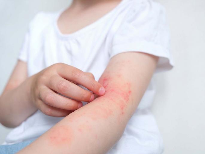 skin care tips these 5 things causes skin infection rapidly in summers | चुका टाळा! रोजच्या 'या' ५ सवयींमुळे होऊ शकतं स्किन इन्फेक्शन; उन्हाळ्यात दहापट वाढतो धोका