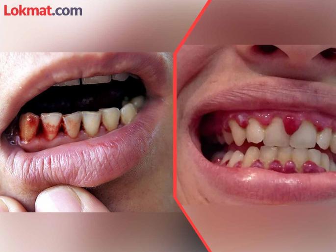 Teeth fall out, gums bleed; What causes 'scurvy' disease? | दात गळतात, हिरड्यांतून रक्तस्राव; 'स्कर्वी' आजार कशामुळे होतो ? Teeth fall out, gums bleed; What causes 'scurvy' disease? | दात गळतात, हिरड्यांतून रक्तस्राव; 'स्कर्वी' आजार कशामुळे होतो ?