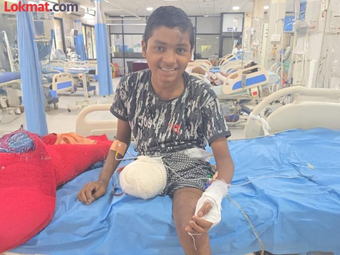 A hemophiliac patient's leg was amputated to save his life; a success for the surgery department of the medical college | हिमोफिलियाच्या रुग्णाचा पाय कापून वाचविला जीव; मेडिकलच्या सर्जरी विभागाचे यश