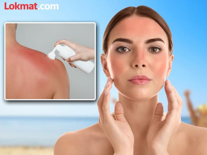 The sun is burning the skin; the only way to avoid sunburn | उन्हामुळे कातडी भाजतेय; 'सनबर्न' पासून वाचण्याचा एकमेव उपाय The sun is burning the skin; the only way to avoid sunburn | उन्हामुळे कातडी भाजतेय; 'सनबर्न' पासून वाचण्याचा एकमेव उपाय