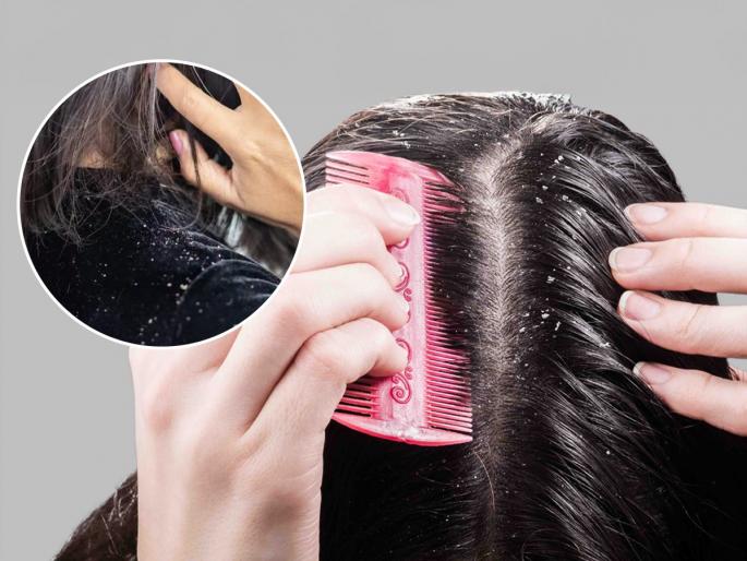 5 reasons why dandruff does not reduce, see types of dandruff | डोक्यातला कोंडा कमीच न होण्याची ५ कारणं, त्वचेनुसार कोंड्याचा त्रास बदलतो-पाहा नेमके उपाय