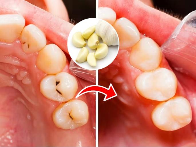 Home remedies Garlic And Salt For Tooth Cavity Effective Home Remedies For Tooth Cavities | दातांच्या समस्यांवर इवलीशी लसूण पाकळी ठरते प्रभावी उपाय! दात दिसतील मोत्यासारखे पांढरेशुभ्र...