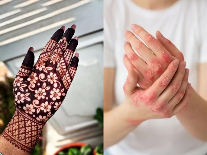 do you get allergy on hands after applying mehendi doctor told why this happens and how to treat allergicreaction to henna | लग्नात मेहेंदी काढण्यापूर्वी करा १ टेस्ट! मेहेंदी असली आहे की केमिकलची भेसळ ओळखा, भन्नाट ट्रिक...