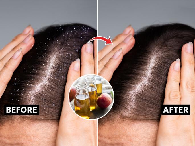 Apple Cider Vinegar For Dandruff, How To Use, Benefits Apple Cider Vinegar For Dandruff Simple Way To Use Apple Cider Vinegar for Dandruff | केसांतील डँड्रफ सतत खांद्यावर पडतो ? शाम्पू - तेल बदलूनही फरक नाही, करा व्हिनेगरचा सोपा उपाय...