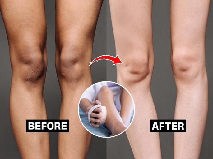 how to clean tanning on knees of kids, simple home remedies for cleaning knees of kids, how to reduce blackness on knees | लहान मुलांचे गुडघे खूप काळवंडून गेले? २ सोपे उपाय- काळेपणा जाऊन गुडघे स्वच्छ होतील