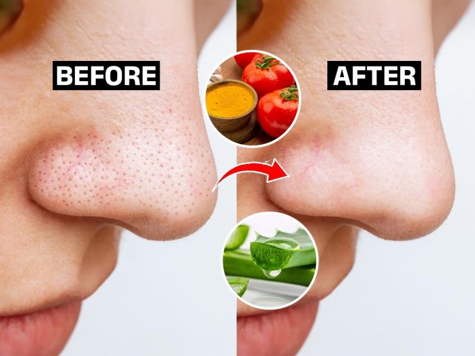How To Get Rid of Blackheads & Whiteheads How To Get Rid of Blackheads, Whiteheads, and Open Pores Naturally How to remove blackheads and whiteheads permanently with home remedies | नाकावरच्या ब्लॅकहेड्समुळे चेहरा निस्तेज दिसतो? १ सोपा उपाय - ५ मिनिटांत ब्लॅकहेड्स गायब, दुखणारही नाही...