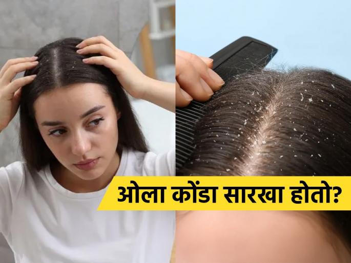 Oily skin means a lot of dandruff, see what to do when you have wet dandruff | तेलकट त्वचा म्हणजे भरपूर कोंडा, पाहा ओला कोंडा झाल्यावर काय करायचे