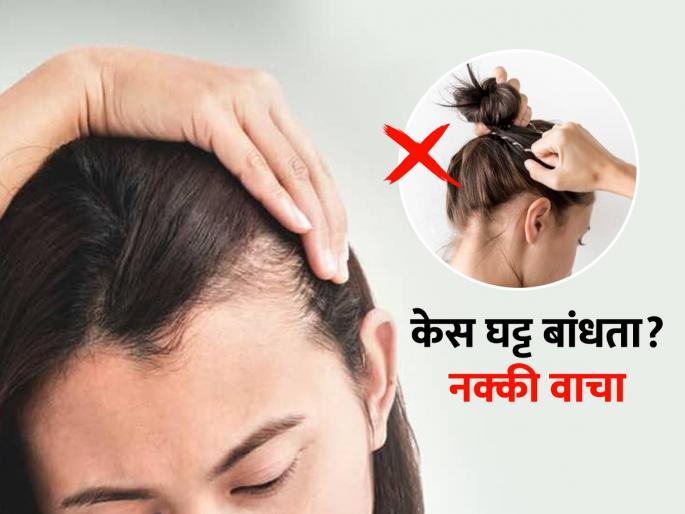 Long hair but bald in front, does your forehead look big? See the reasons | केस मोठे पण समोर टक्कल, कपाळ मोठं दिसतं? समोरचे केस विरळ होण्याचे कारण..