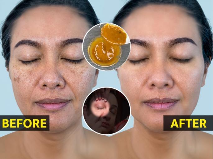 main reasons and causes for pigmentation on skin, how to get rid of pigmented skin, home hacks to reduce pigmentation | 'या' कारणामुळे चेहऱ्यावरचे पिगमेंटेशन वाढतात! बघा उपाय- डाग जाऊन चेहरा उजळेल