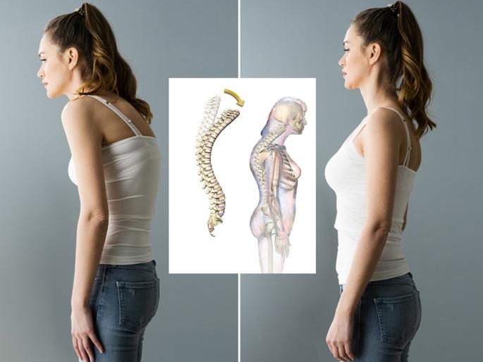 struggling with Kyphosis ? If you don't take care of it in time, it can get worst | पाठीची कमान झाली, पोक काढून चालता? वेळीच 'अशी' काळजी घेतली नाही तर कायमचे वाकाल