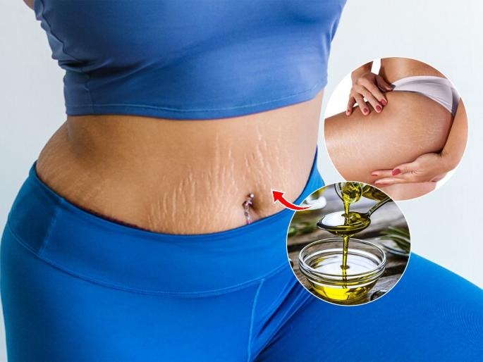 Stretch marks on the stomach and thighs will be reduced, mix this substance with coconut oil, great solution at low cost | पोट -मांड्यांवरील स्ट्रेच मार्क्स होतील कमी, खोबऱ्याच्या तेलात मिसळा हा पदार्थ, कमी खर्चात मस्त उपाय