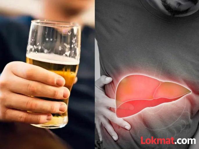 A disease that affects even non-drinkers; How to keep liver cirrhosis at bay? | दारू न पिणाऱ्यांनाही होणारा आजार; 'लिव्हर सिरॉसिस'ला कसे दूर ठेवाल? A disease that affects even non-drinkers; How to keep liver cirrhosis at bay? | दारू न पिणाऱ्यांनाही होणारा आजार; 'लिव्हर सिरॉसिस'ला कसे दूर ठेवाल?