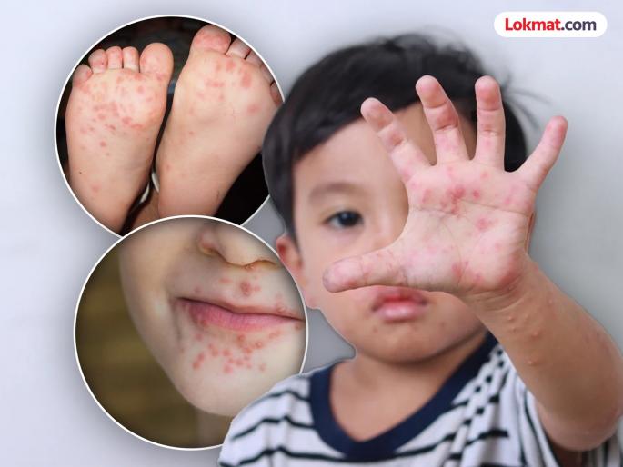 Looks like chickenpox, but different: Hand, foot, mouth syndrome disease on the rise | कांजिण्यासारखा दिसणारा, पण वेगळा: हॅन्ड, फूट, माउथ सिंड्रोम आजार वाढतोय Looks like chickenpox, but different: Hand, foot, mouth syndrome disease on the rise | कांजिण्यासारखा दिसणारा, पण वेगळा: हॅन्ड, फूट, माउथ सिंड्रोम आजार वाढतोय