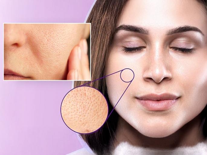 How to reduce open pores naturally Home remedy for large pores on face looks older due to open pores | वय पंचविस पण दिसताय चाळिशीच्या, ओपन पोर्समुळे चेहरा खराब? १ सोपी ट्रिक, महिनाभरात दिसेल फरक