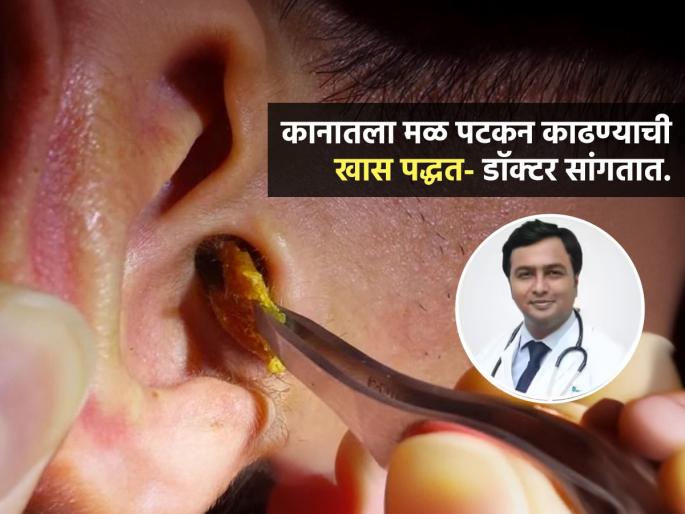 3 Easy Ways To Remove Shares Ear Wax Senior Ent Surgeon At Apollo Hospital Dr. Naseeruddin | १० सेकंदात निघेल कानात साचलेला मळ; डॉक्टर सांगतात 3 उपाय, मळ निघेल-ऐकूही नीट येईल