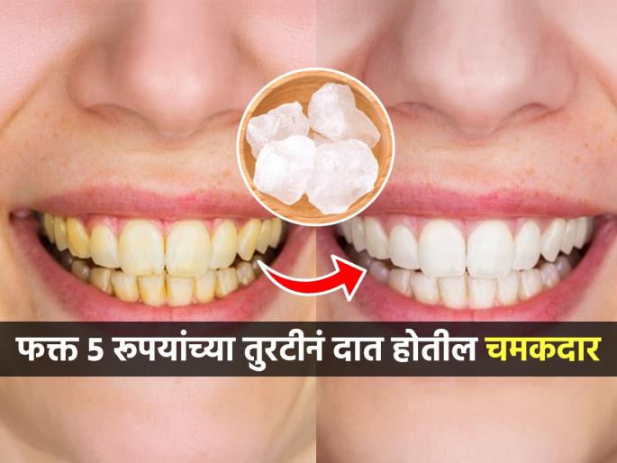 Teeth whitening Remedies At Home : How To Use Fitkari Alum For Teeth whitening | रोज घासले तरी दात पिवळेच? ५ रुपयांच्या तुरटीचा १ उपाय, चमकदार-पांढरेशुभ्र होतील दात